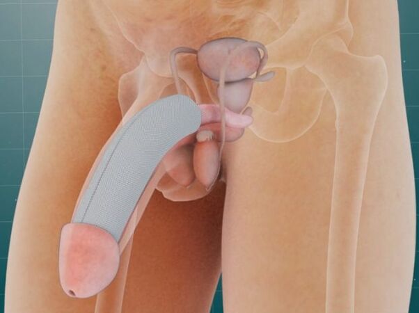Le pénis après l'introduction d'un implant spécial sous la peau