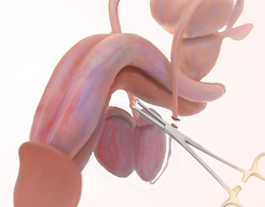 ligamentotomie pour l'agrandissement du pénis